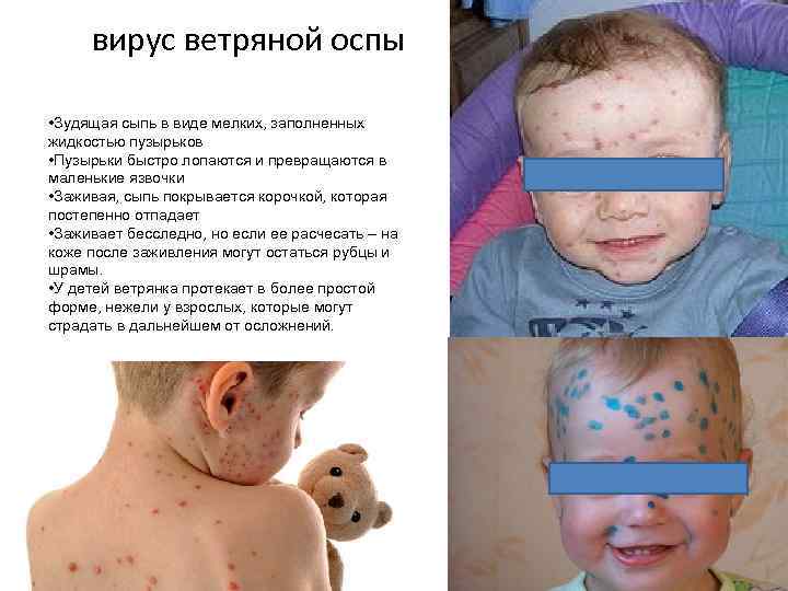 вирус ветряной оспы • Зудящая сыпь в виде мелких, заполненных жидкостью пузырьков • Пузырьки