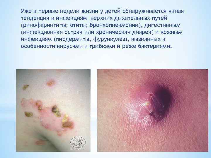 Уже в первые недели жизни у детей обнаруживается явная тенденция к инфекциям верхних дыхательных