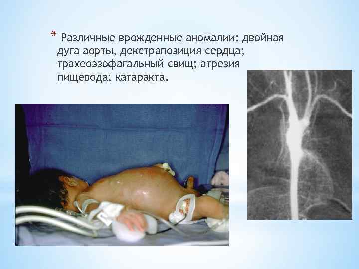 * Различные врожденные аномалии: двойная дуга аорты, декстрапозиция сердца; трахеоэзофагальный свищ; атрезия пищевода; катаракта.