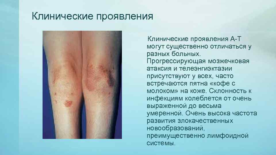 Клинические проявления А-Т могут существенно отличаться у разных больных. Прогрессирующая мозжечковая атаксия и телеэнгиэктазии