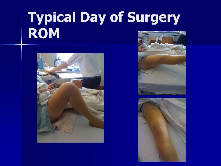 Typical Day of Surgery ROM 