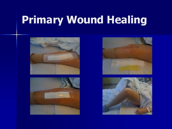 Primary Wound Healing 