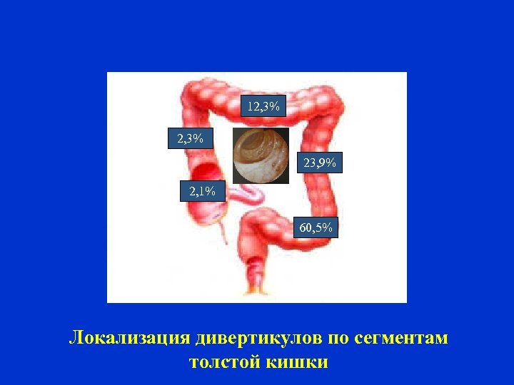 12, 3% 23, 9% 2, 1% 60, 5% Локализация дивертикулов по сегментам толстой кишки