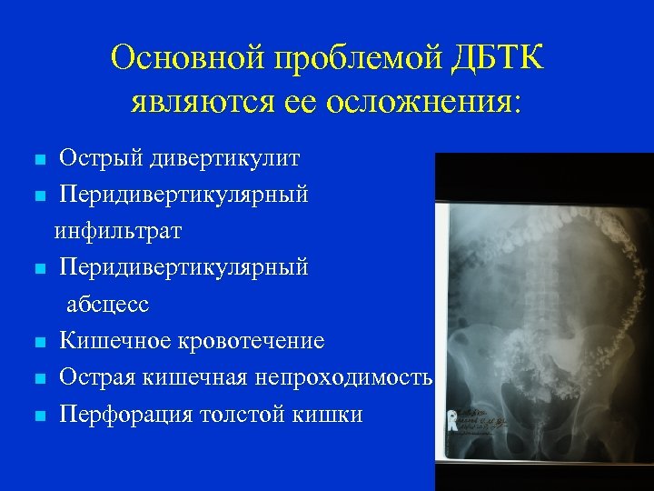 Основной проблемой ДБТК являются ее осложнения: Острый дивертикулит n Перидивертикулярный инфильтрат n Перидивертикулярный абсцесс