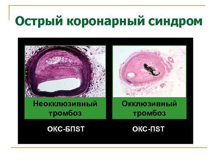 Острый коронарный синдром Неокклюзивный тромбоз ОКС-БПSТ ОКС-ПSТ 