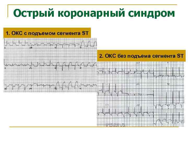 Острый коронарный синдром 1. ОКС c подъемом сегмента ST 2. ОКС без подъема сегмента