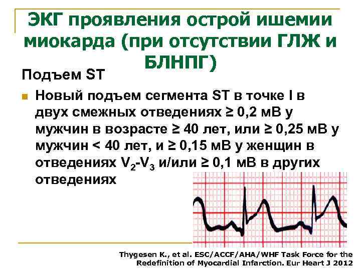 ЭКГ проявления острой ишемии миокарда (при отсутствии ГЛЖ и БЛНПГ) Подъем ST n Новый