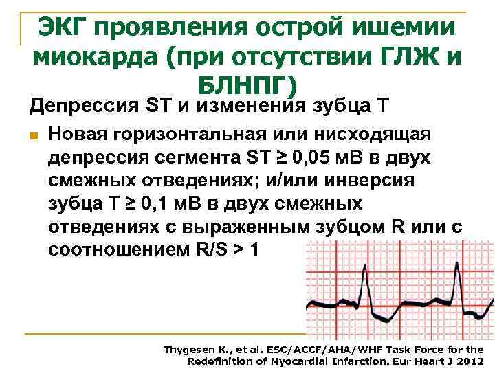 ЭКГ проявления острой ишемии миокарда (при отсутствии ГЛЖ и БЛНПГ) Депрессия ST и изменения