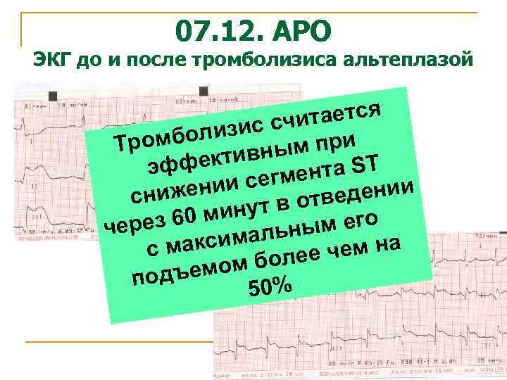 07. 12. АРО ЭКГ до и после тромболизиса альтеплазой ается ис счит мболиз Тро