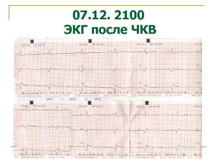 07. 12. 2100 ЭКГ после ЧКВ 