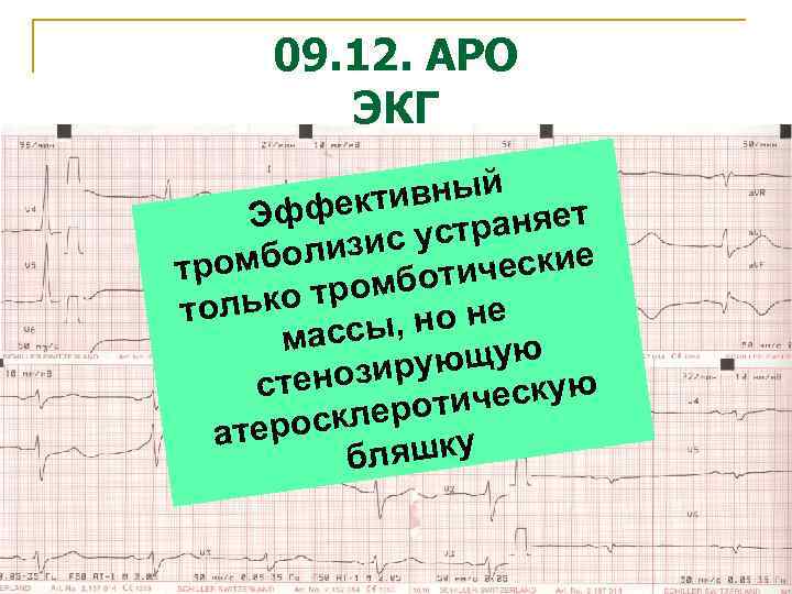 09. 12. АРО ЭКГ вный ффекти Э аняет ис устр мболиз тро ческие омботи