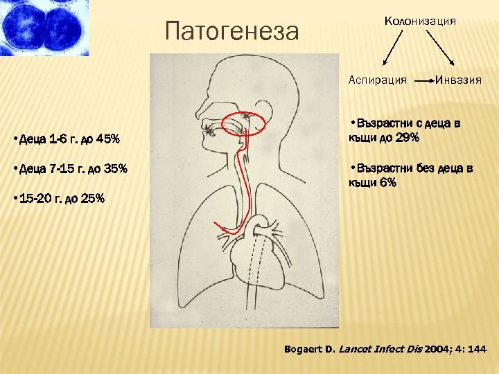 Патогенеза Колонизация Аспирация • Деца 1 -6 г. до 45% • Деца 7 -15