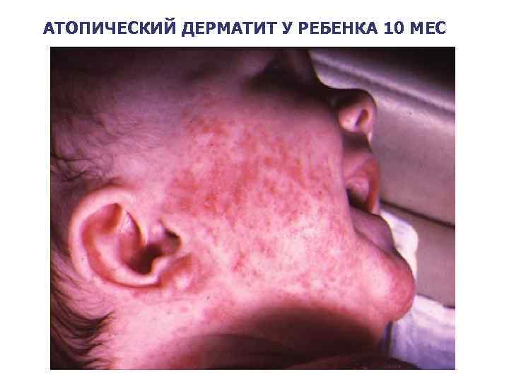 АТОПИЧЕСКИЙ ДЕРМАТИТ У РЕБЕНКА 10 МЕС 24 