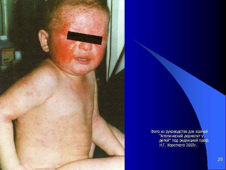 Фото из руководства для врачей “Атопический дерматит у детей” под редакцией проф. Н. Г.