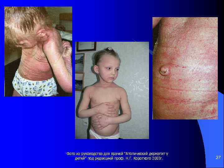 Фото из руководства для врачей “Атопический дерматит у детей” под редакцией проф. Н. Г.