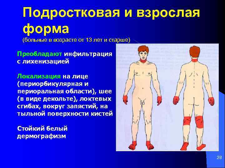 Подростковая и взрослая форма (больные в возрасте от 13 лет и старше) Преобладают инфильтрация