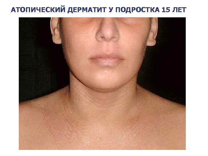 АТОПИЧЕСКИЙ ДЕРМАТИТ У ПОДРОСТКА 15 ЛЕТ 29 