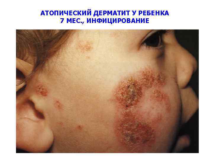 АТОПИЧЕСКИЙ ДЕРМАТИТ У РЕБЕНКА 7 МЕС. , ИНФИЦИРОВАНИЕ 40 
