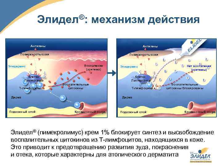 Элидел®: механизм действия Антигены Поверхность кожи Эпидермис Поверхность кожи Воспаление (эритема) Клетка Лангерганса Т-лимфоциты
