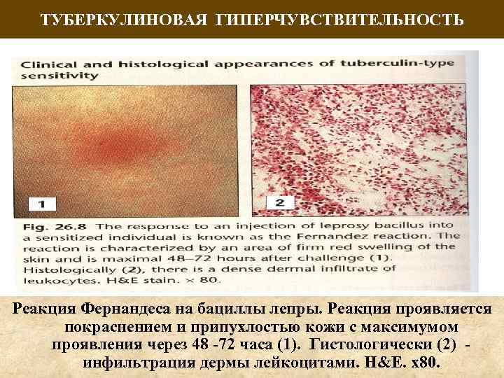 ТУБЕРКУЛИНОВАЯ ГИПЕРЧУВСТВИТЕЛЬНОСТЬ Реакция Фернандеса на бациллы лепры. Реакция проявляется покраснением и припухлостью кожи с