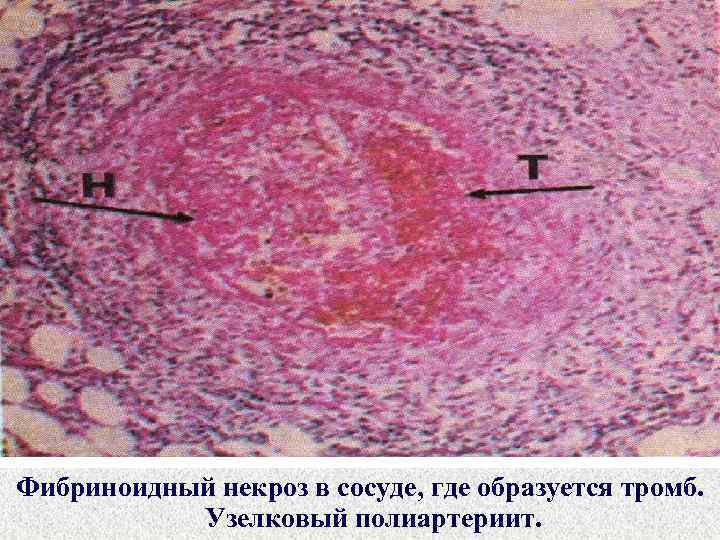 Узелковый полиартериит фото