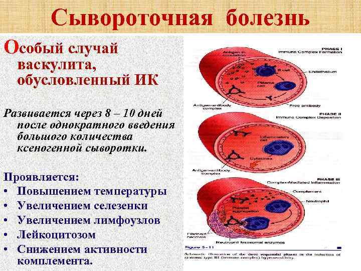 Сывороточная болезнь Особый случай васкулита, обусловленный ИК Развивается через 8 – 10 дней после