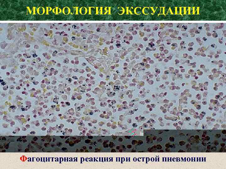 МОРФОЛОГИЯ ЭКССУДАЦИИ Фагоцитарная реакция при острой пневмонии 