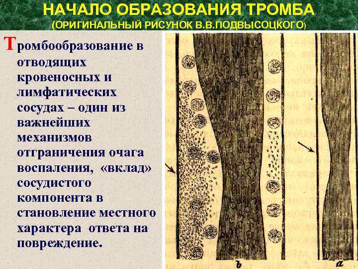 НАЧАЛО ОБРАЗОВАНИЯ ТРОМБА (ОРИГИНАЛЬНЫЙ РИСУНОК В. В. ПОДВЫСОЦКОГО) Тромбообразование в отводящих кровеносных и лимфатических