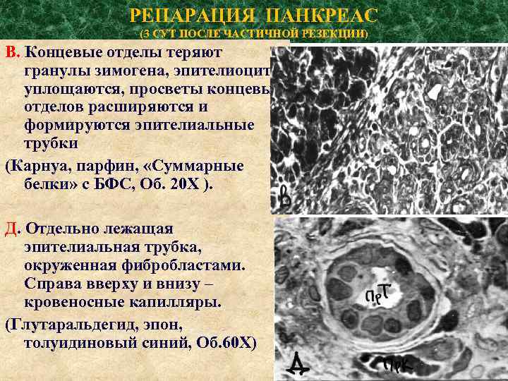РЕПАРАЦИЯ ПАНКРЕАС (3 СУТ ПОСЛЕ ЧАСТИЧНОЙ РЕЗЕКЦИИ) В. Концевые отделы теряют гранулы зимогена, эпителиоциты