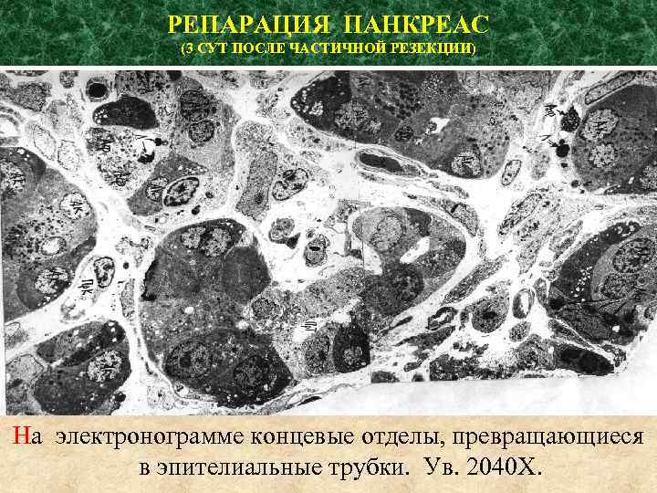 РЕПАРАЦИЯ ПАНКРЕАС (3 СУТ ПОСЛЕ ЧАСТИЧНОЙ РЕЗЕКЦИИ) На электронограмме концевые отделы, превращающиеся в эпителиальные