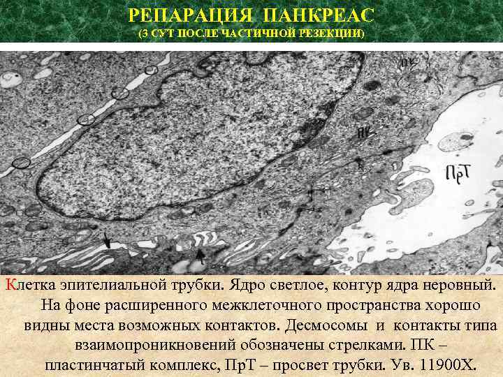 РЕПАРАЦИЯ ПАНКРЕАС (3 СУТ ПОСЛЕ ЧАСТИЧНОЙ РЕЗЕКЦИИ) Клетка эпителиальной трубки. Ядро светлое, контур ядра