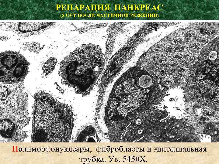 РЕПАРАЦИЯ ПАНКРЕАС (3 СУТ ПОСЛЕ ЧАСТИЧНОЙ РЕЗЕКЦИИ) Полиморфонуклеары, фибробласты и эпителиальная трубка. Ув. 5450