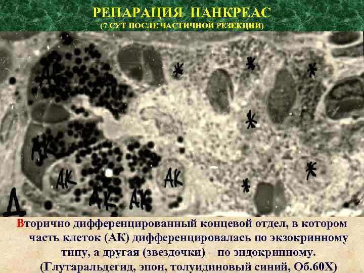 РЕПАРАЦИЯ ПАНКРЕАС (7 СУТ ПОСЛЕ ЧАСТИЧНОЙ РЕЗЕКЦИИ) Вторично дифференцированный концевой отдел, в котором часть