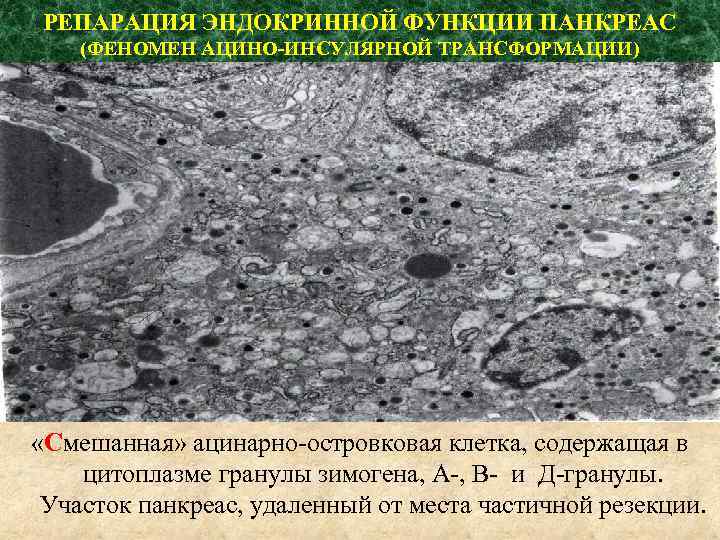 РЕПАРАЦИЯ ЭНДОКРИННОЙ ФУНКЦИИ ПАНКРЕАС (ФЕНОМЕН АЦИНО-ИНСУЛЯРНОЙ ТРАНСФОРМАЦИИ) «Смешанная» ацинарно-островковая клетка, содержащая в цитоплазме гранулы