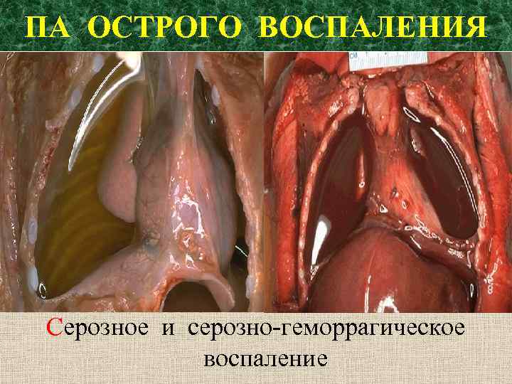 ПА ОСТРОГО ВОСПАЛЕНИЯ Серозное и серозно-геморрагическое воспаление 