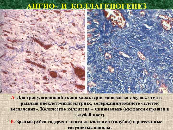 АНГИО- И КОЛЛАГЕНОГЕНЕЗ А. Для грануляционной ткани характерно множество сосудов, отек и рыхлый внеклеточный