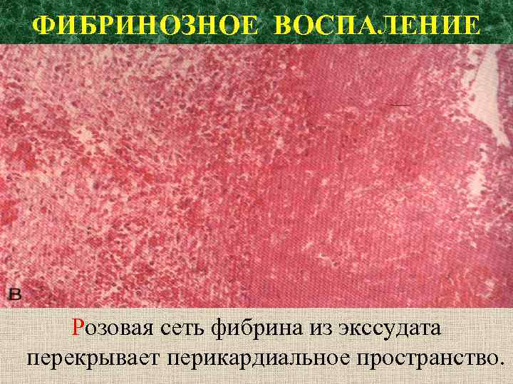 ФИБРИНОЗНОЕ ВОСПАЛЕНИЕ Розовая сеть фибрина из экссудата перекрывает перикардиальное пространство. 
