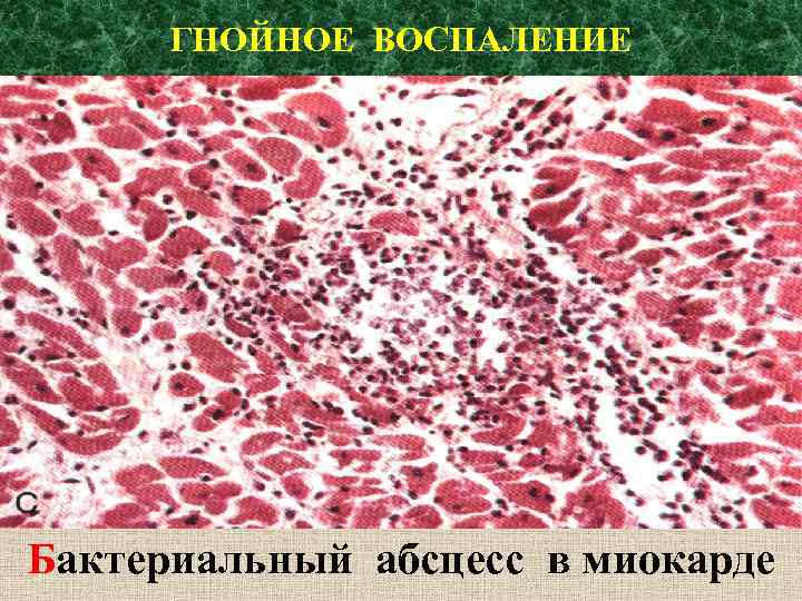ГНОЙНОЕ ВОСПАЛЕНИЕ Бактериальный абсцесс в миокарде 