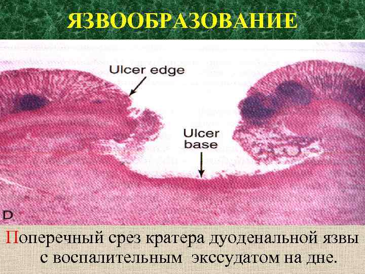 ЯЗВООБРАЗОВАНИЕ Поперечный срез кратера дуоденальной язвы с воспалительным экссудатом на дне. 