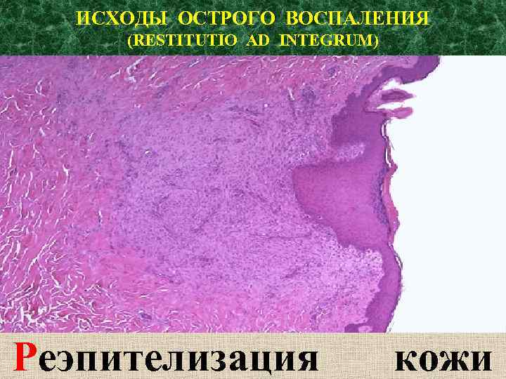 ИСХОДЫ ОСТРОГО ВОСПАЛЕНИЯ (RESTITUTIO AD INTEGRUM) Реэпителизация кожи 