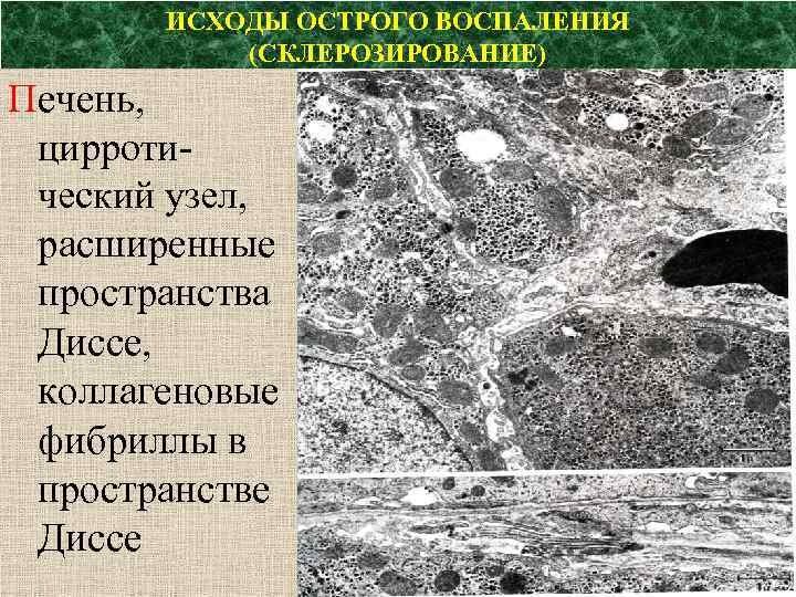 ИСХОДЫ ОСТРОГО ВОСПАЛЕНИЯ (СКЛЕРОЗИРОВАНИЕ) Печень, цирротический узел, расширенные пространства Диссе, коллагеновые фибриллы в пространстве