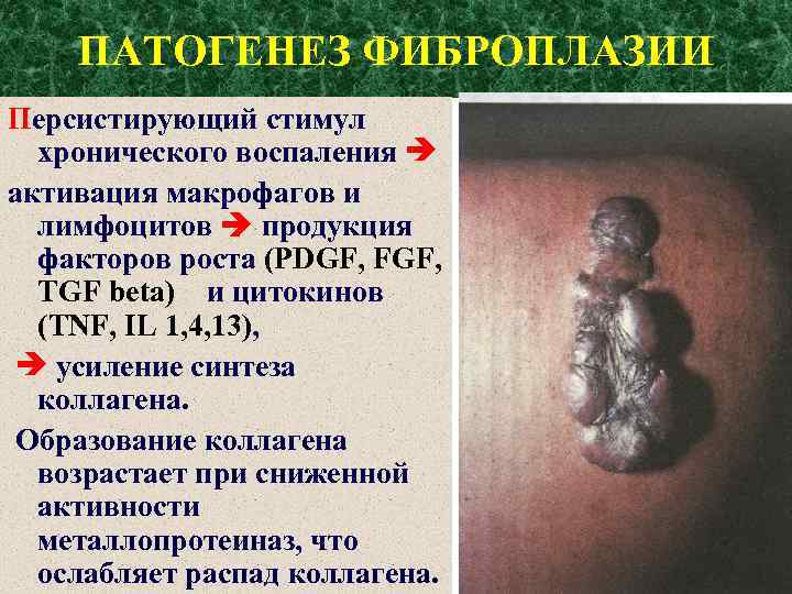 ПАТОГЕНЕЗ ФИБРОПЛАЗИИ Персистирующий стимул хронического воспаления активация макрофагов и лимфоцитов продукция факторов роста (PDGF,