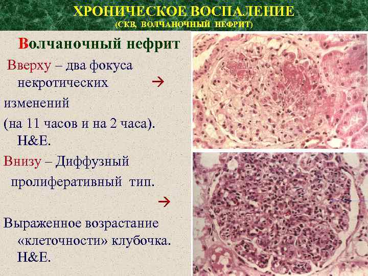 ХРОНИЧЕСКОЕ ВОСПАЛЕНИЕ (СКВ, ВОЛЧАНОЧНЫЙ НЕФРИТ) Волчаночный нефрит Вверху – два фокуса некротических изменений (на