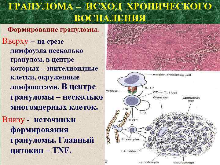 ГРАНУЛОМА – ИСХОД ХРОНИЧЕСКОГО ВОСПАЛЕНИЯ Формирование грануломы. Вверху – на срезе лимфоузла несколько гранулом,