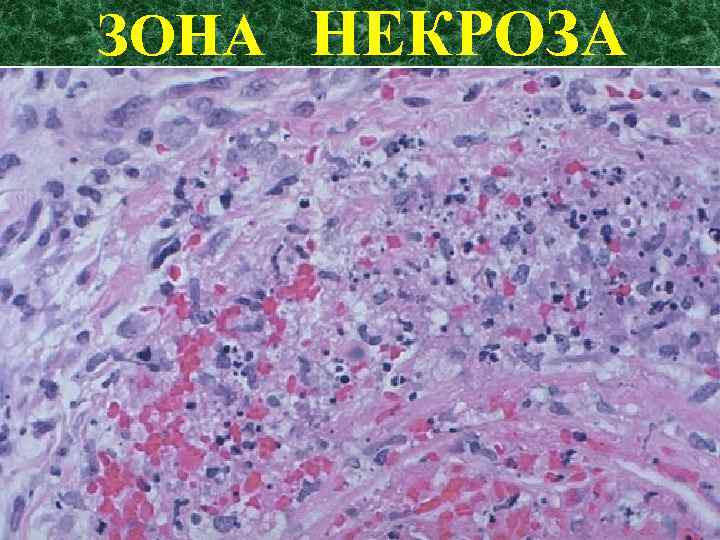 ЗОНА НЕКРОЗА (ОСТРОЕ ВОСПАЛЕНИЕ) 