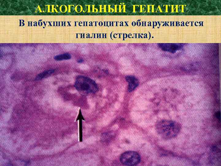 АЛКОГОЛЬНЫЙ ГЕПАТИТ В набухших гепатоцитах обнаруживается гиалин (стрелка). 