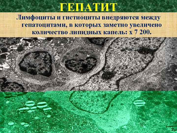 ГЕПАТИТ Лимфоциты и гистиоциты внедряются между гепатоцитами, в которых заметно увеличено количество липидных капель: