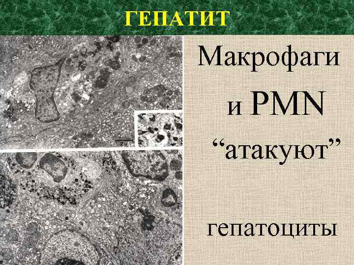 ГЕПАТИТ Макрофаги и PMN “атакуют” гепатоциты 