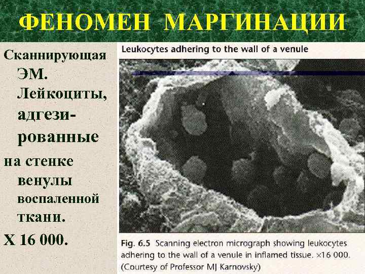 ФЕНОМЕН МАРГИНАЦИИ Сканнирующая ЭМ. Лейкоциты, адгезированные на стенке венулы воспаленной ткани. Х 16 000.
