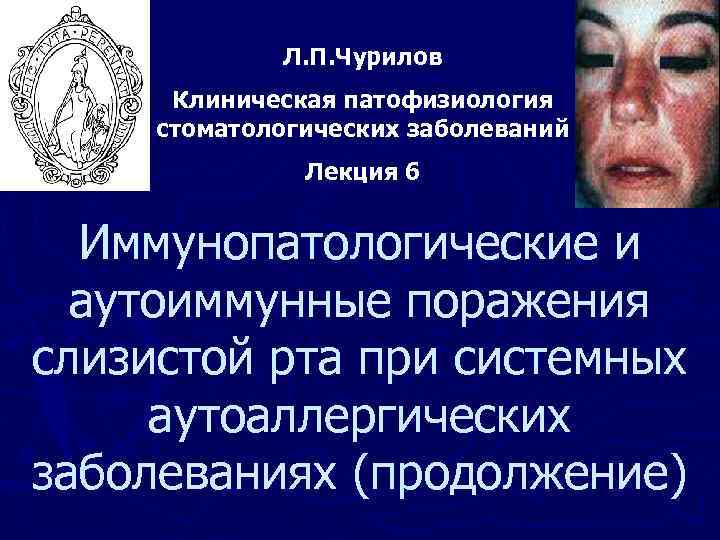 Л. П. Чурилов Клиническая патофизиология стоматологических заболеваний Лекция 6 Иммунопатологические и аутоиммунные поражения слизистой